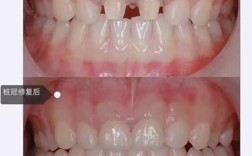 刚种牙后的修复图能直观呈现哪些恢复关键点？种植体周围软组织形态与咬合功能状态如何通过图像评估？