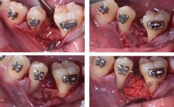 牙齿正畸关闭间隙