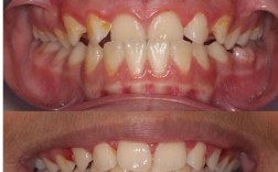 正畸期间牙齿松动严重