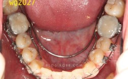 武广增正畸转矩簧