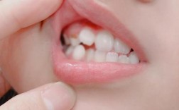 小孩蛀牙用什么好方法能安全解决？