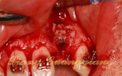 有缺失牙 植骨后正畸