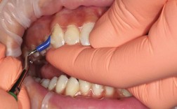 正畸附件粘结技术改进