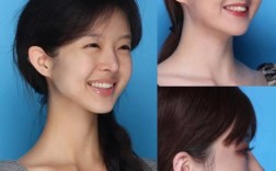 牙齿矫正脸型对比，矫正前后脸型变化有多大？对比图揭秘！