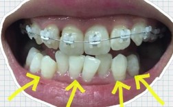 矫正牙齿会导致牙龈萎缩吗？图片揭秘风险与应对