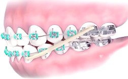 牙齿矫正皮筋中线