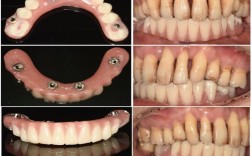 allon4种植牙取模