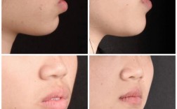 牙齿矫正 对比图