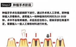 植牙多久可以装冠