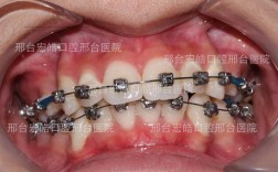 公立医院牙齿矫正效果如何？价格和流程靠谱吗？