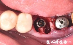 种植牙底部塞牙是什么原因？该怎么处理？