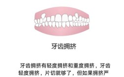 正畸拔除四个第二磨牙