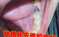 不种牙上牙松动