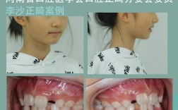 后牙咬合不齐，局部正畸能矫正好吗？怎么做？