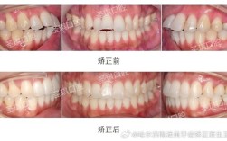 开颌手术VS正畸，选哪个更优？效果、风险、适用情况如何权衡？