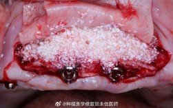 正畸骨钉有脓液是怎么回事？需要怎么处理？