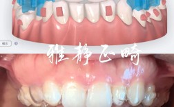 国产隐正畸怎么样