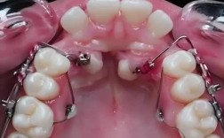 牙根炎症状态下正畸牵引治疗可行吗？