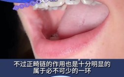 正畸橡皮链的清洁