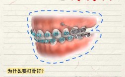正畸骨钉会打偏吗？医生如何精准把控植入位置？