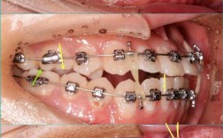 最新牙齿正畸手术