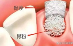 种牙为何要用植骨粉和骨膜？
