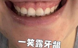 南京牙齿正畸矫正后露牙龈笑是什么原因？如何通过调整方案改善笑容美观问题？