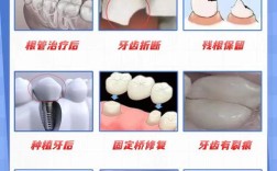 烤瓷牙与种植牙如何选？哪种更适合长期使用？