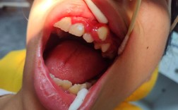 口腔正畸拉错位牙