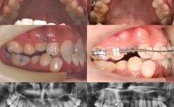 成人正畸选华西口腔效果如何？适合哪些牙齿问题？费用和周期怎么样？