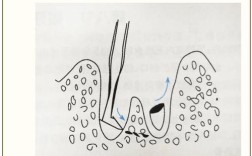 下颌磨牙的拔除方法