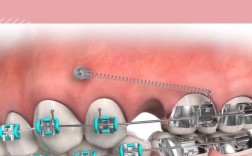 正畸打骨钉会脱落吗