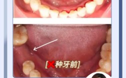 种牙过程 植骨多久后
