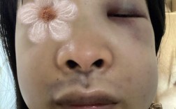 种牙为何要植入骨粉？牙脸会有影响吗？