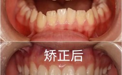 口腔正畸对比照片