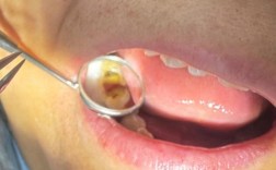 刚正畸后舌头不舒服