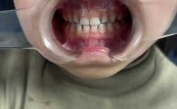 乳牙反颌矫治方法有哪些具体类型和适用选择？