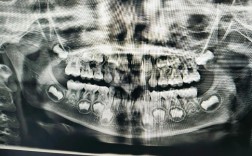 小牙片拍摄的正确方法是什么？关键步骤有哪些？