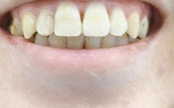 正畸后牙侧壁出现一条线，是牙齿损伤还是矫正正常反应？