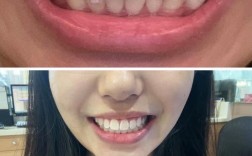 上海隐形矫正效果如何？价格与适合人群有哪些？