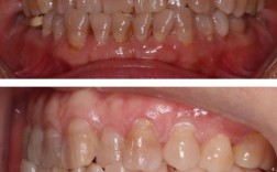 矫正牙齿后牙齿变黑？矫正器惹的祸还是清洁没做到位？