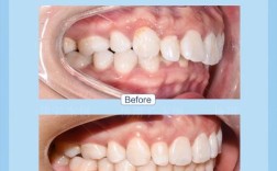 隐形正畸解决深覆盖