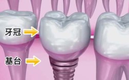 全口种牙过程视频能看清哪些种植关键步骤？