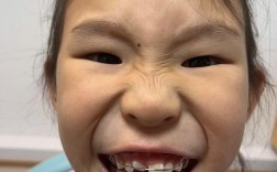 儿童10岁前牙齿正畸为何宜早不宜迟？