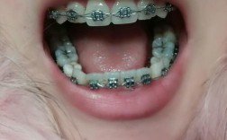 13岁矫正牙齿拔4颗