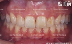 矫正时牙齿变色，到底是什么原因导致的？