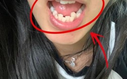 正畸后牙根歪斜，究竟是什么原因导致的？