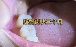 拔完牙能立即种牙吗？