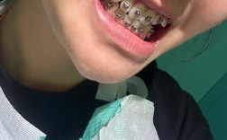 正畸中线歪得厉害，是什么原因导致的？