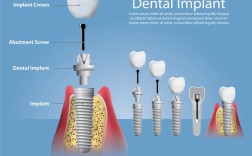 英式无痛种牙那家好